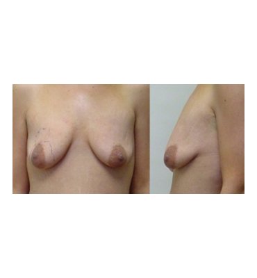 Breast Lift With Implants Before